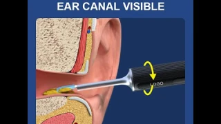3 Million Pixels Visual Ear Cleaner Otoscope @X1