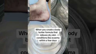 Eczema Cream - Body Butter Review - Whipped Body Butter For Eczema #whippedsheabutter #eczema
