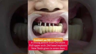 Basal implants in 7 days-New Teeth to a Denmark Patient-ऊपर के पूरे नए दांत केवल 7 दिनों में #shorts