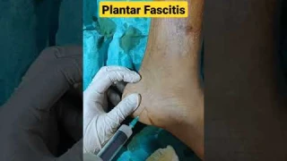 Heel Pain Injection ✓✓ | Fast & Immediate Relief| #plantarfasciatis #heelpain #heelpaintreatment |