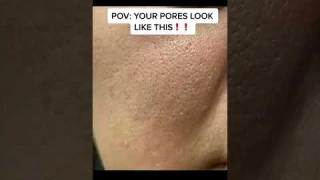 Do you PORES LOOK THIS LARGE?!!!! #skincareroutine #skincare